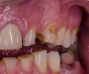 zuby zkažené