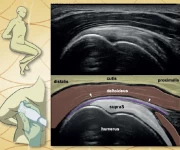 Ultrazvuk myoskeletální